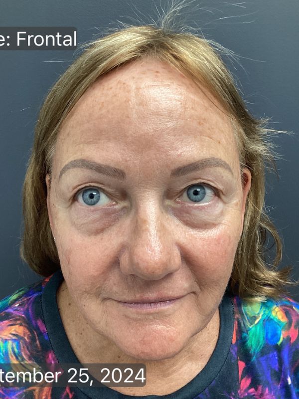 Facelift Before & After Image