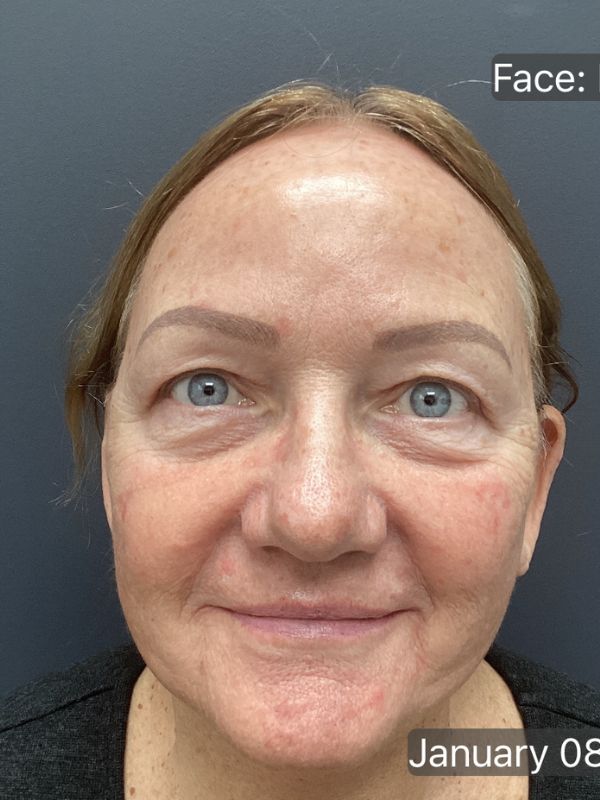 Facelift Before & After Image