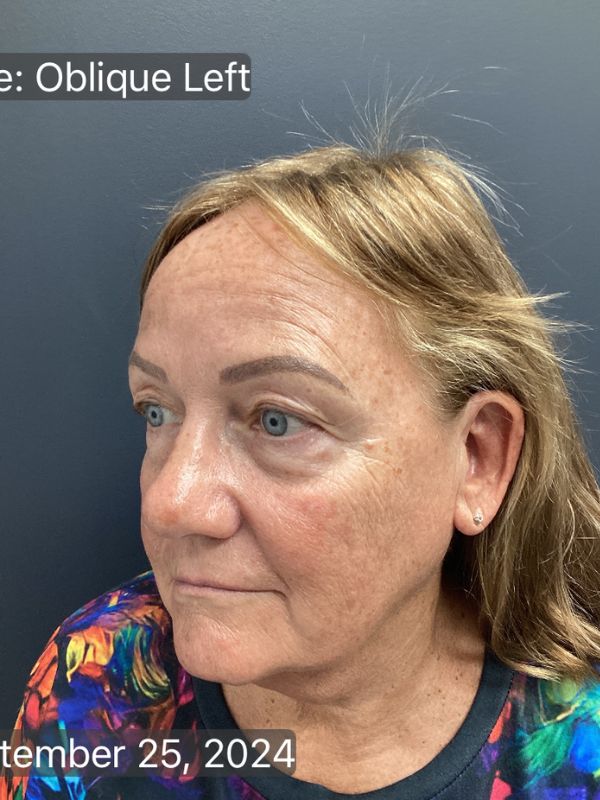 Facelift Before & After Image