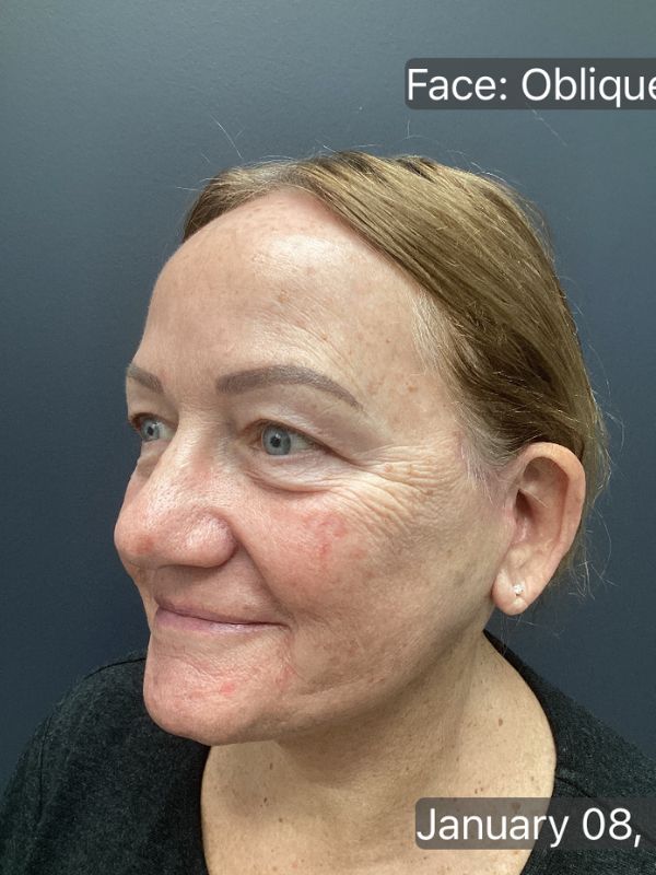 Facelift Before & After Image