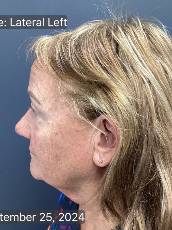 Facelift Before & After Image