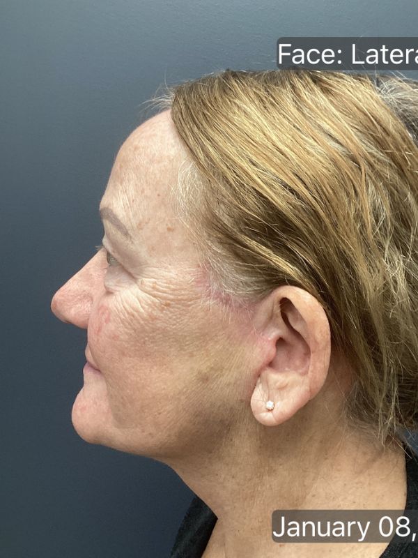 Facelift Before & After Image