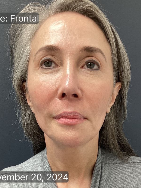Facelift Before & After Image