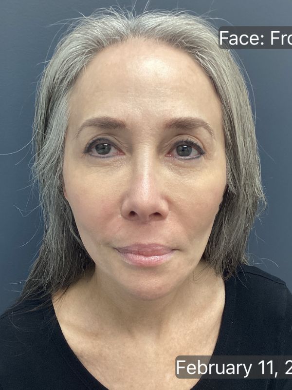 Facelift Before & After Image