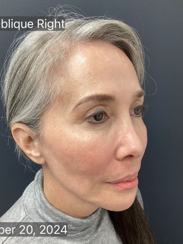 Facelift Before & After Image