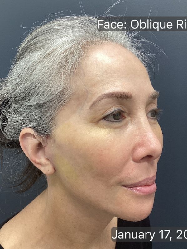 Facelift Before & After Image