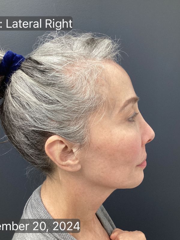 Facelift Before & After Image