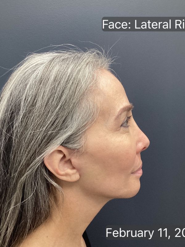 Facelift Before & After Image