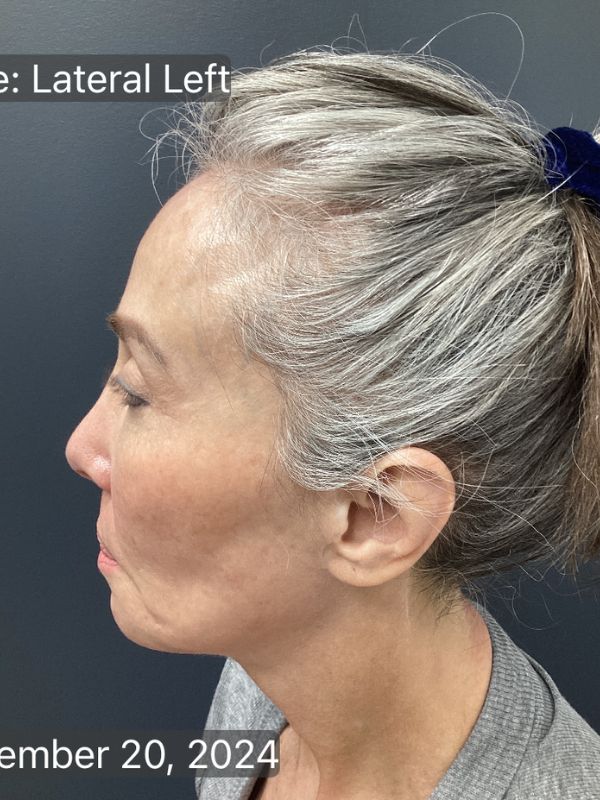 Facelift Before & After Image