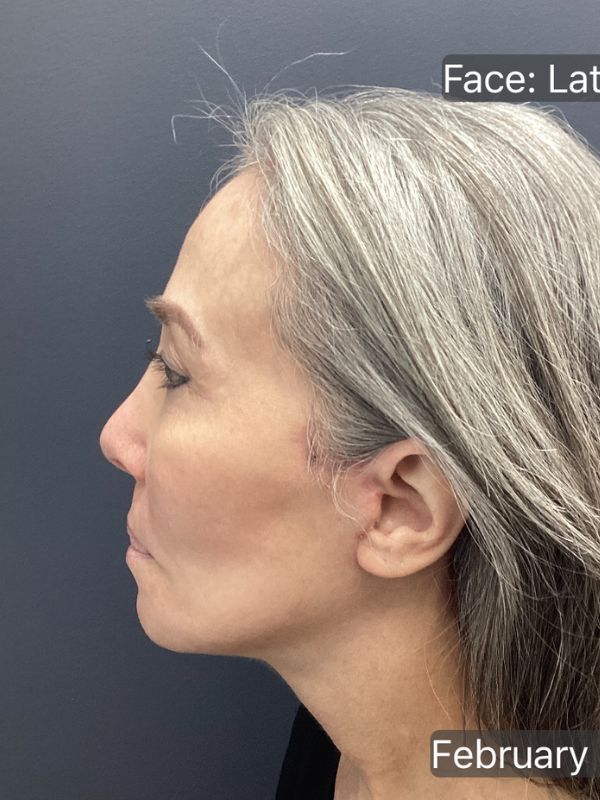 Facelift Before & After Image