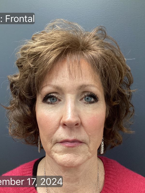 Facelift Before & After Image