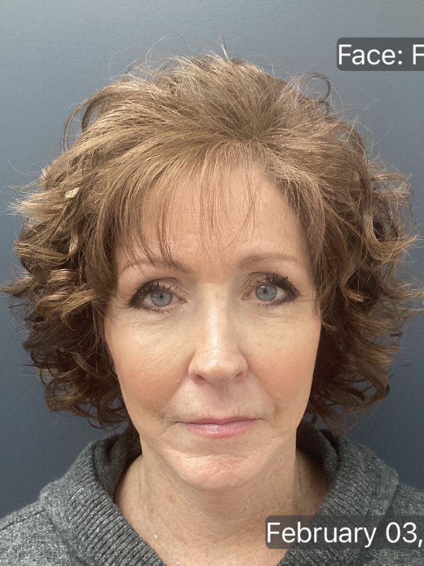Facelift Before & After Image
