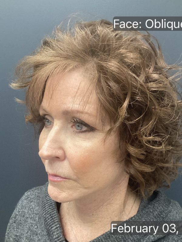 Facelift Before & After Image
