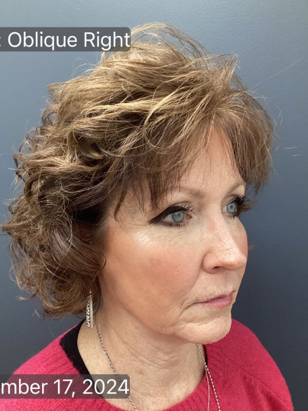 Facelift Before & After Image