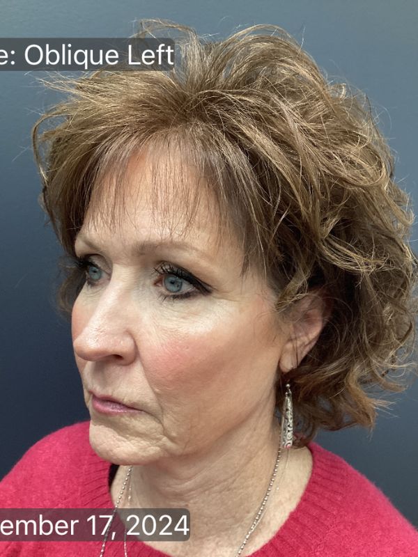 Facelift & Neck Lift 01 Before Image