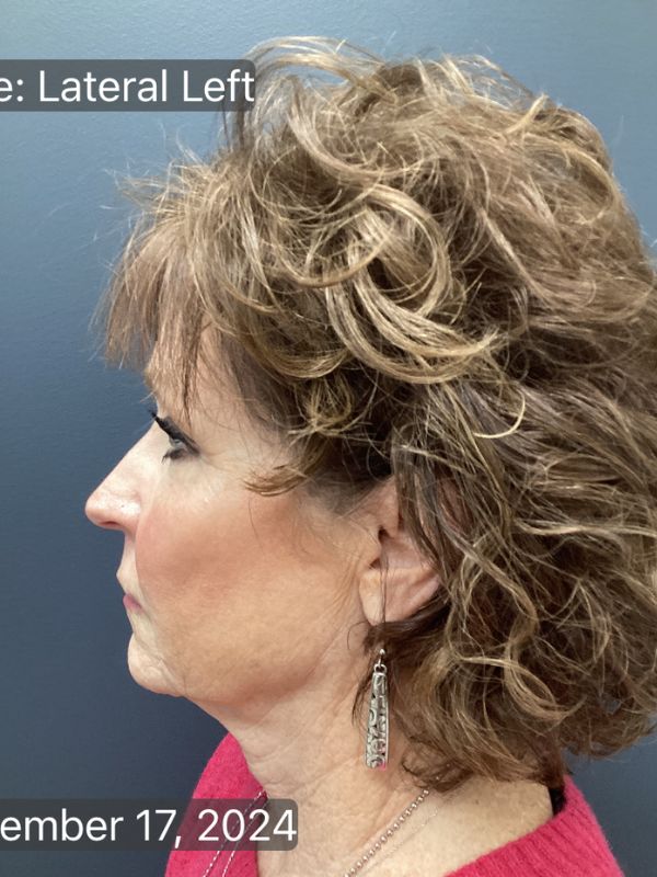 Facelift & Neck Lift 01 Before Image