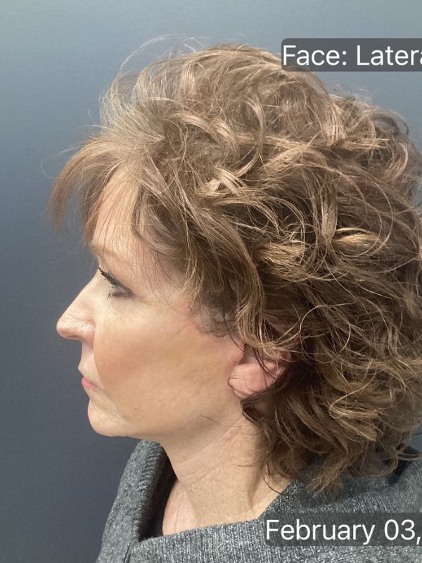 Facelift & Neck Lift 01 After Image