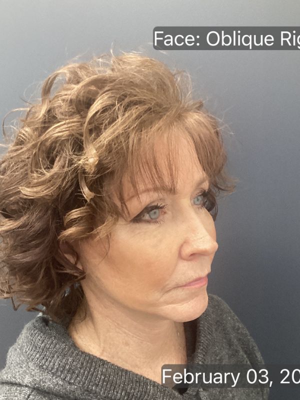 Facelift & Neck Lift 01 After Image