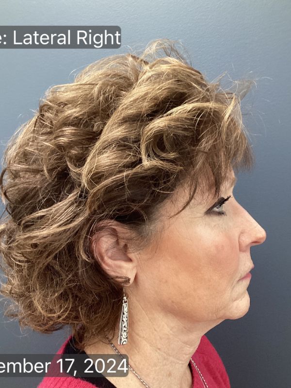 Facelift & Neck Lift 01 Before Image