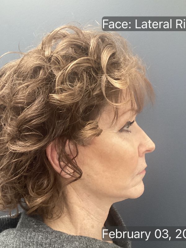 Facelift & Neck Lift 01 After Image