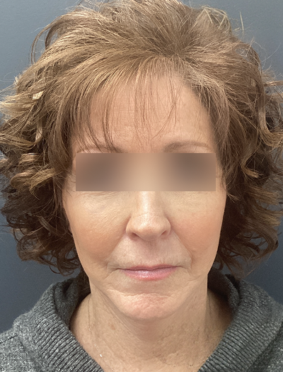 Facelift & Neck Lift 1 After Image