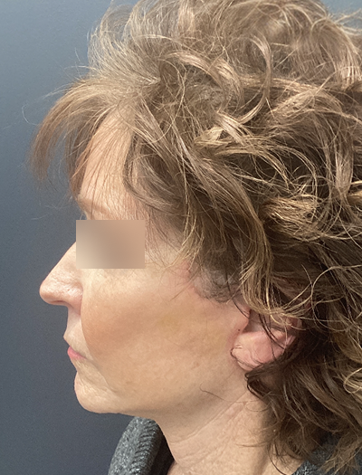 Facelift & Neck Lift 1 After Image
