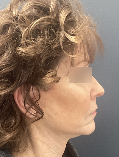 Facelift & Neck Lift 1 After Image