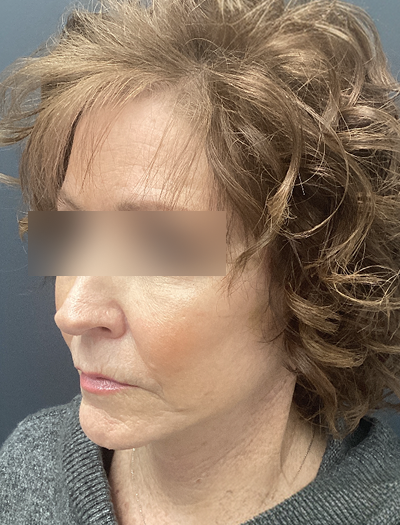 Facelift & Neck Lift 1 After Image