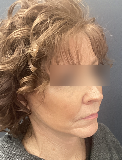 Facelift & Neck Lift 1 After Image