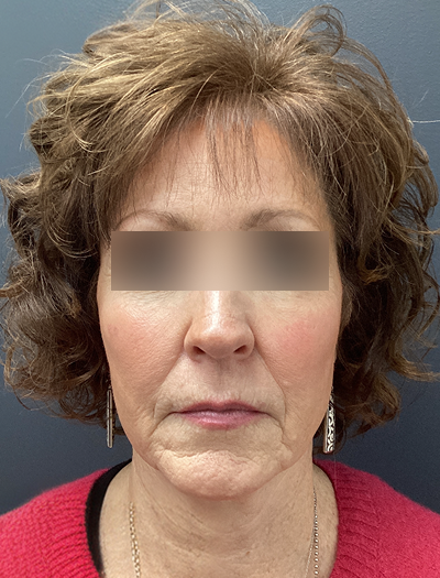 Facelift & Neck Lift 1 Before Image