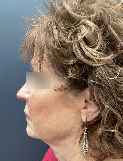 Facelift & Neck Lift 1 Before Image