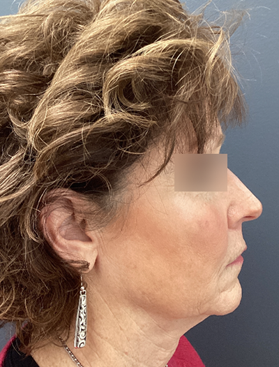 Facelift & Neck Lift 1 Before Image