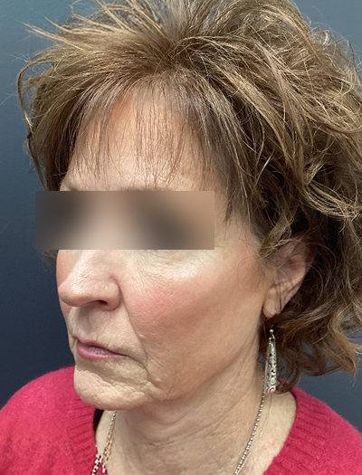 Facelift & Neck Lift 1 Before Image