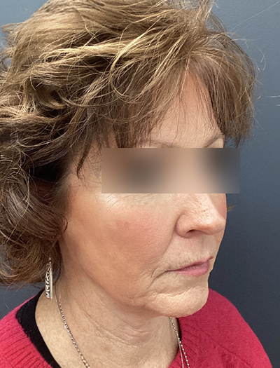 Facelift & Neck Lift 1 Before Image