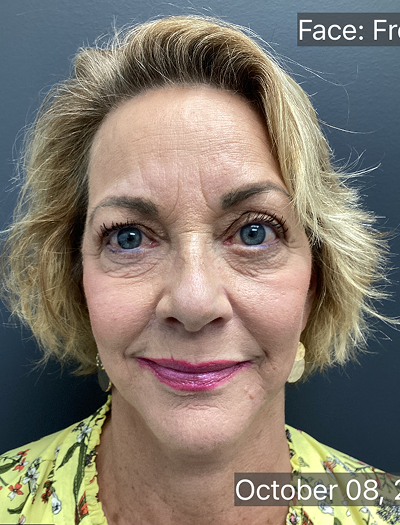 Facelift & Neck Lift 03 After Image