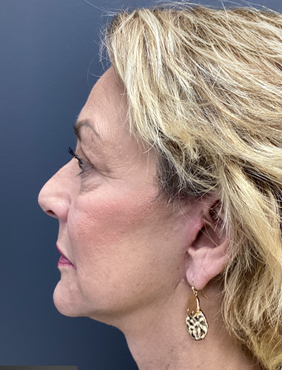 Facelift & Neck Lift 03 After Image