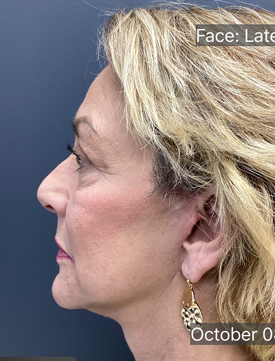 Facelift & Neck Lift 03 After Image