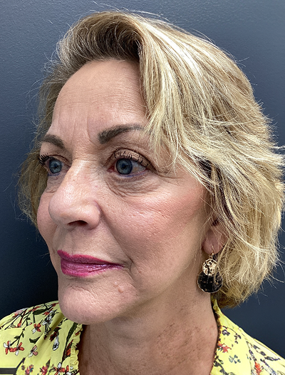 Facelift & Neck Lift 03 After Image