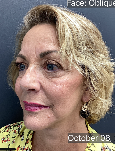 Facelift & Neck Lift 03 After Image