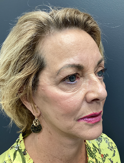 Facelift & Neck Lift 03 After Image