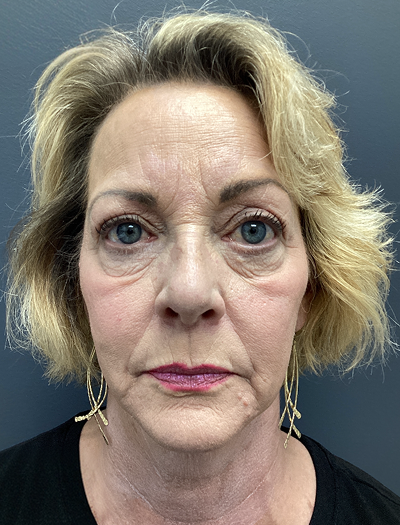 Facelift & Neck Lift 03 Before Image