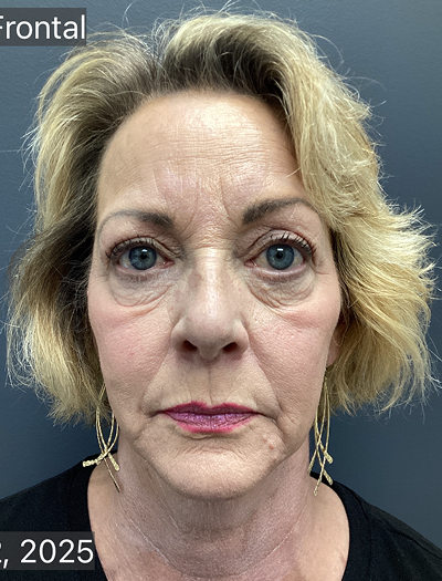Facelift & Neck Lift 03 Before Image