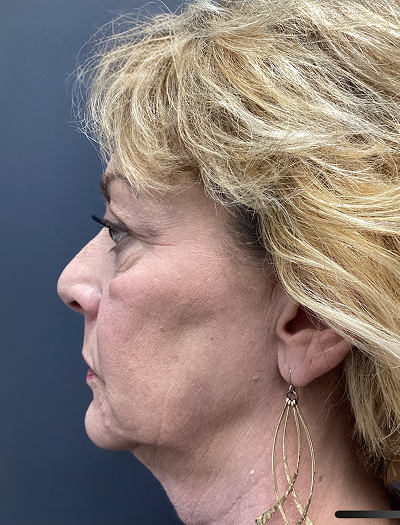 Facelift & Neck Lift 03 Before Image