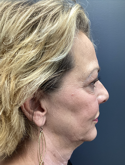 Facelift & Neck Lift 03 Before Image