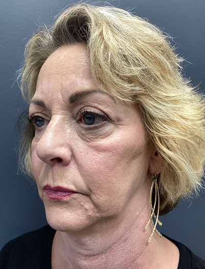 Facelift & Neck Lift 03 Before Image