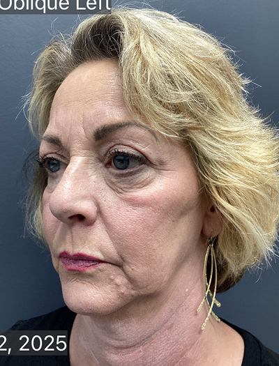 Facelift & Neck Lift 03 Before Image