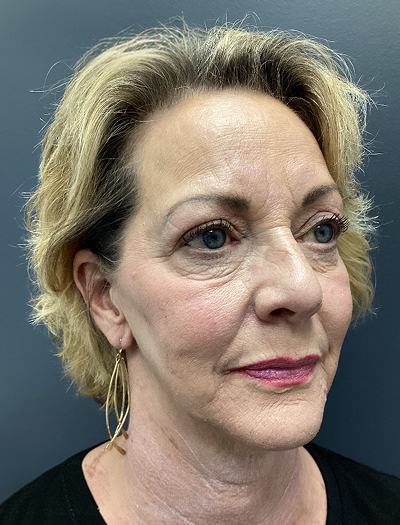 Facelift & Neck Lift 03 Before Image