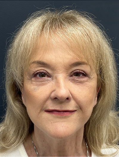 Facelift & Neck Lift 4 After Image