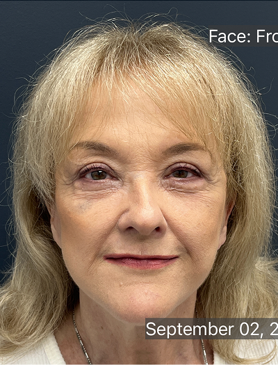 Facelift & Neck Lift 04 After Image