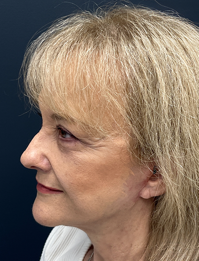 Facelift & Neck Lift 4 After Image